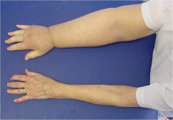 preparati protiv bolova u zglobovima prstiju
